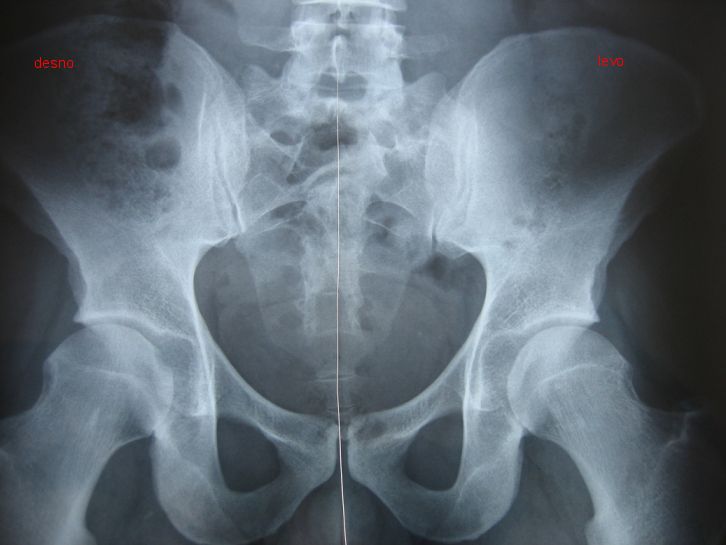 RTG - foto povečava