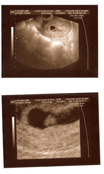 Prvi ultrazvok 8. teden (21.2.07)